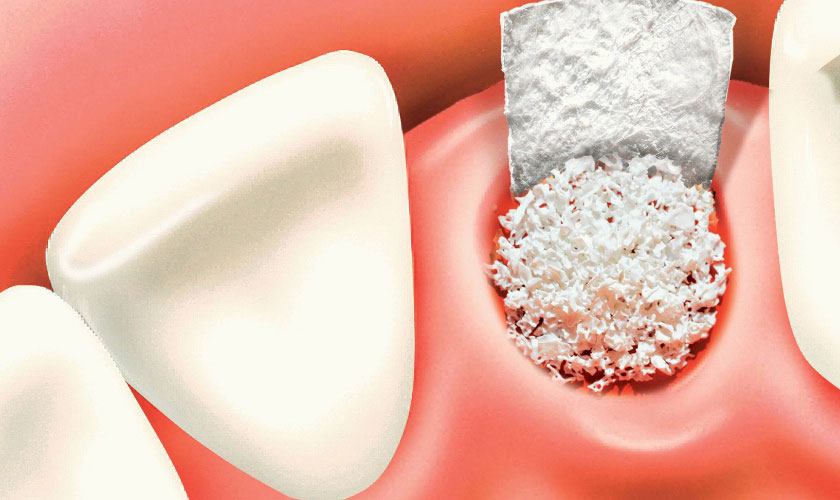 Trường hợp tiêu xương hàm cần phải ghép xương rồi mới cấy ghép implant
