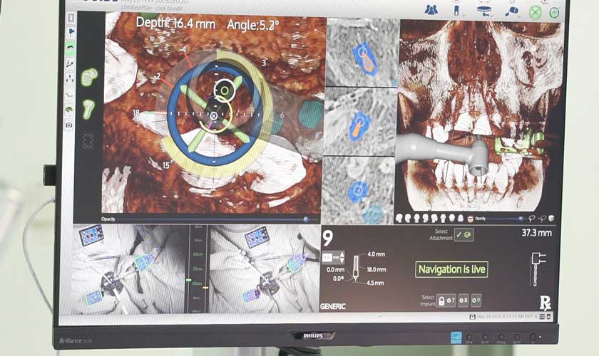 công nghệ định vị cấy ghép Implant Navigation được đánh giá là công nghệ đỉnh cao của ngành Implant Nha khoa