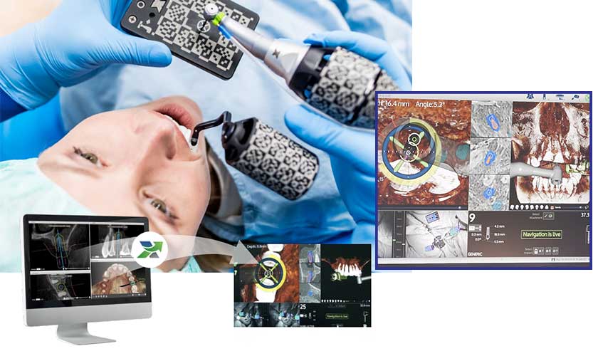 công nghệ định vị là công nghệ tiên tiến nhất hiện này trong Implant Nha khoa