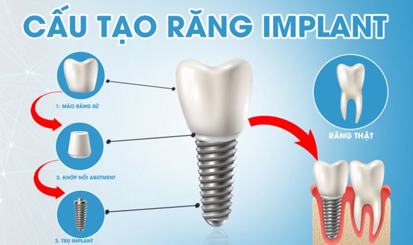 Implant giúp phục hình răng mất toàn diện từ chân răng đến thân răng
