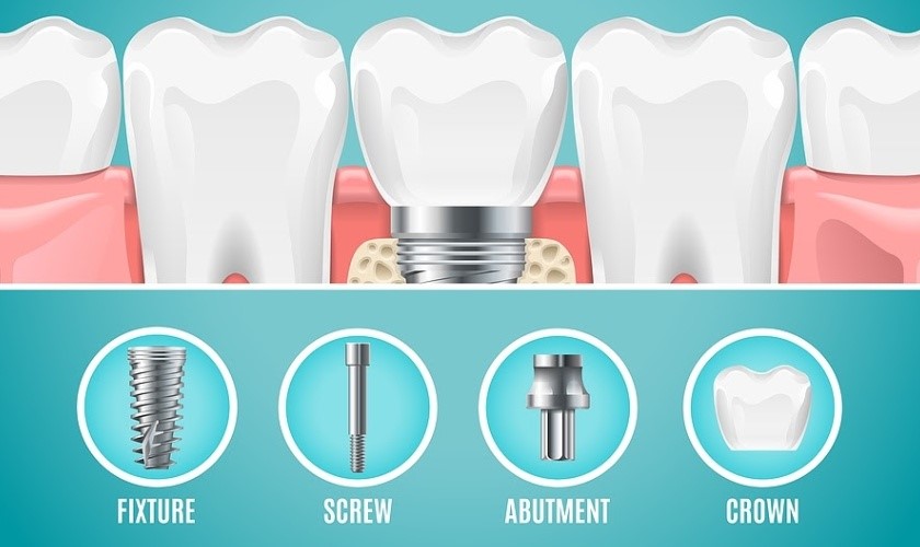 Vật liệu cấy ghép đảm bảo chất lượng Vật liệu cấy ghép đảm bảo chất lượng