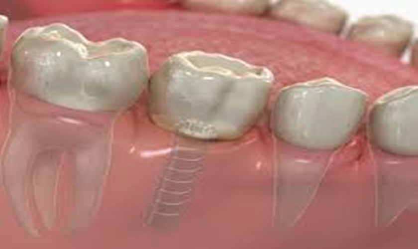 Tùy vào tình trạng của bản thân mình, bạn sẽ có quyết định thực hiện cấy ghép Implant nha khoa