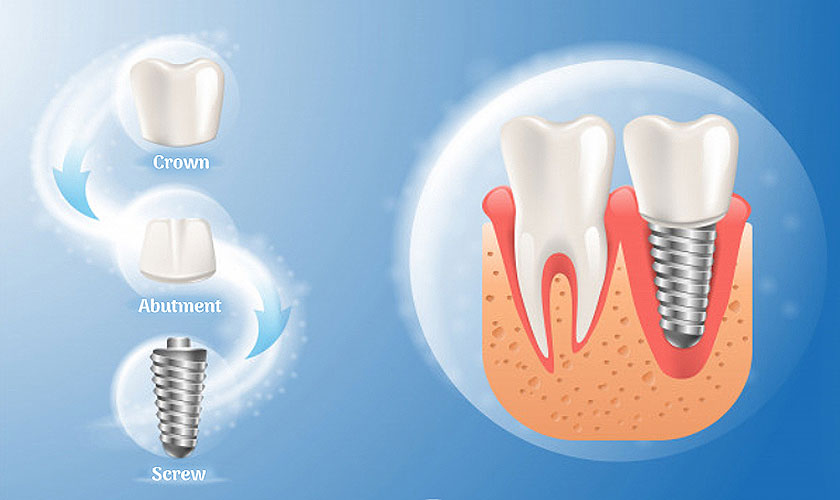 Bảng giá trồng răng Implant