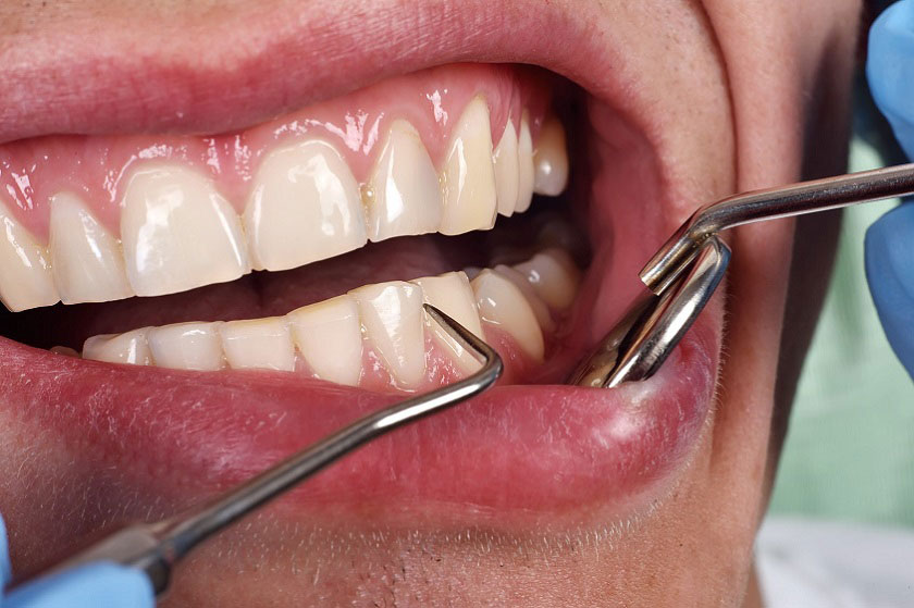 Phòng tránh tình trạng tiêu xương hàm