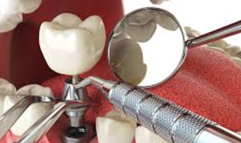 Giải pháp phục hình Implant hiện đại