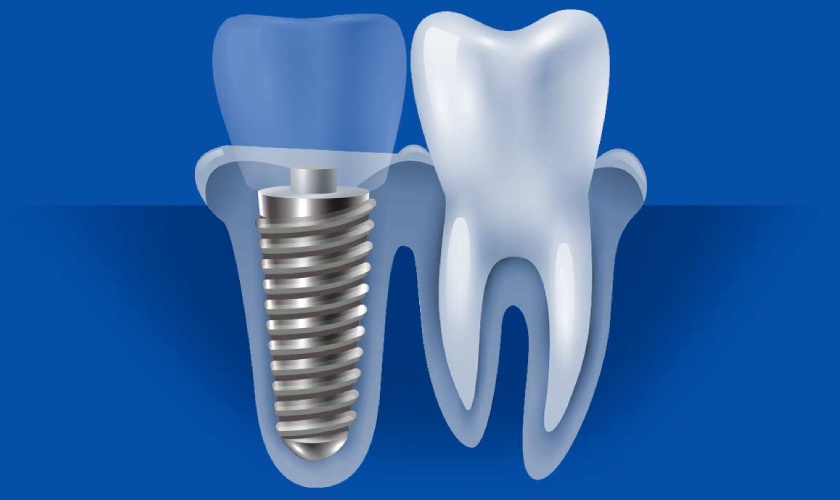 Răng sứ Zirconia - Tất tần tật về răng sứ Zirconia năm 2023