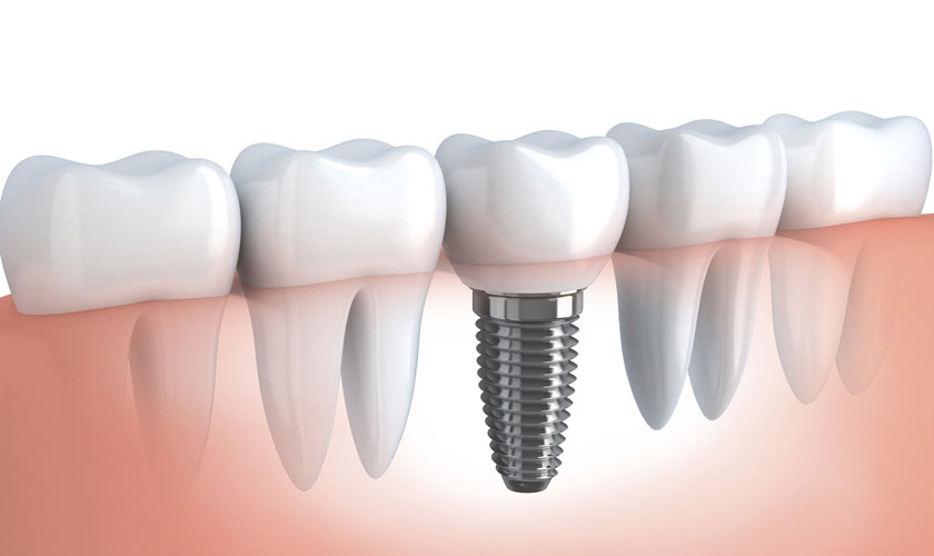 Implant Hàn Quốc