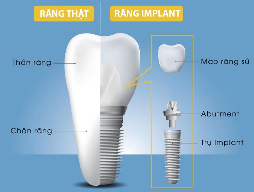 Cấu tạo của một chiếc răng Implant