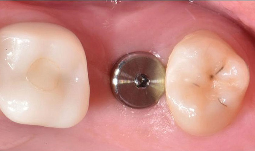 Giá cấy răng Implant sẽ tùy thuộc vào nhiều yếu tố chứ không cố định cho tất cả trường hợp
