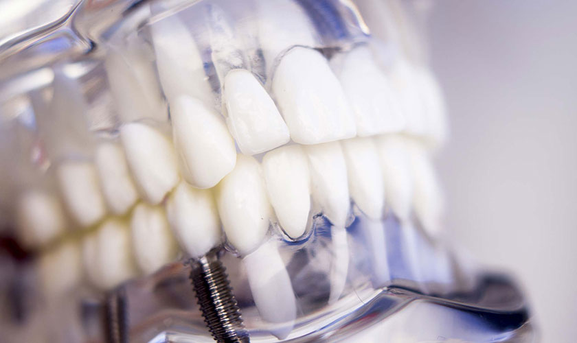 Nha khoa Nhân Tâm là một địa chỉ cấy răng implant chất lượng cao với giá rẻ