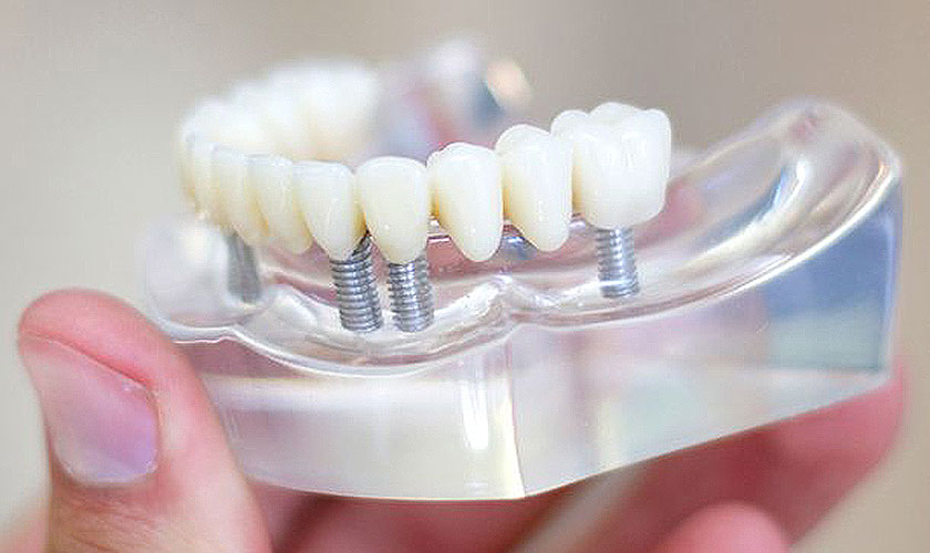 Hiện nay có 2 phương pháp cấy ghép Implant tốt là implant Pháp và Implant Mỹ