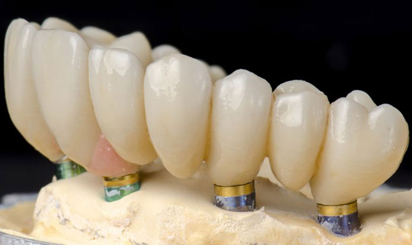 Nha khoa Nhân Tâm là một địa chỉ cấy ghép răng implant tại tphcm uy tín