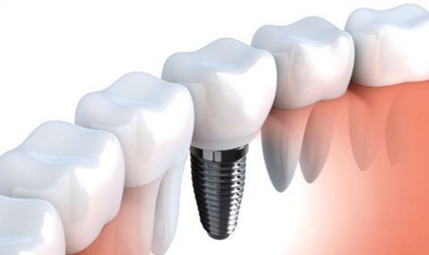Implant có những ưu nhược điểm nào?