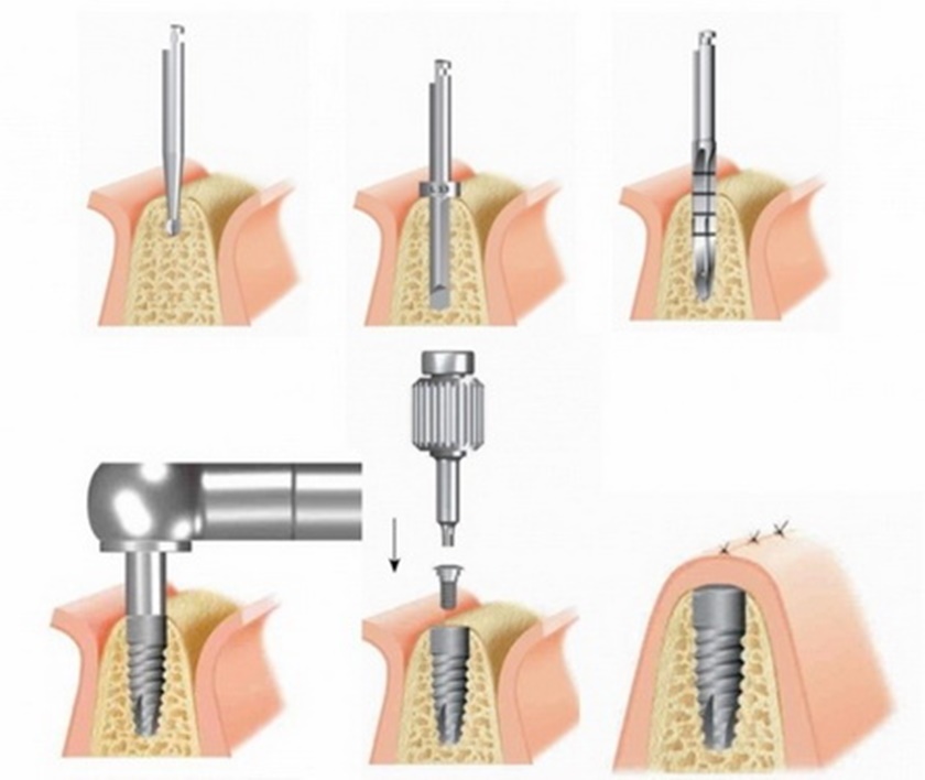 Quy trình cấy ghép Implant tại nha khoa