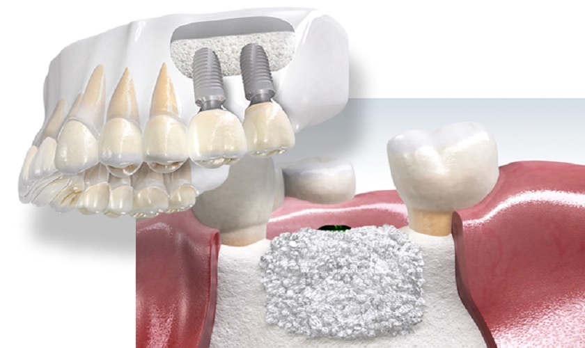 Cấu tạo răng Implant
