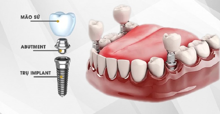 Chi phí trồng răng Implant chịu ảnh hưởng từ nhiều yếu tố