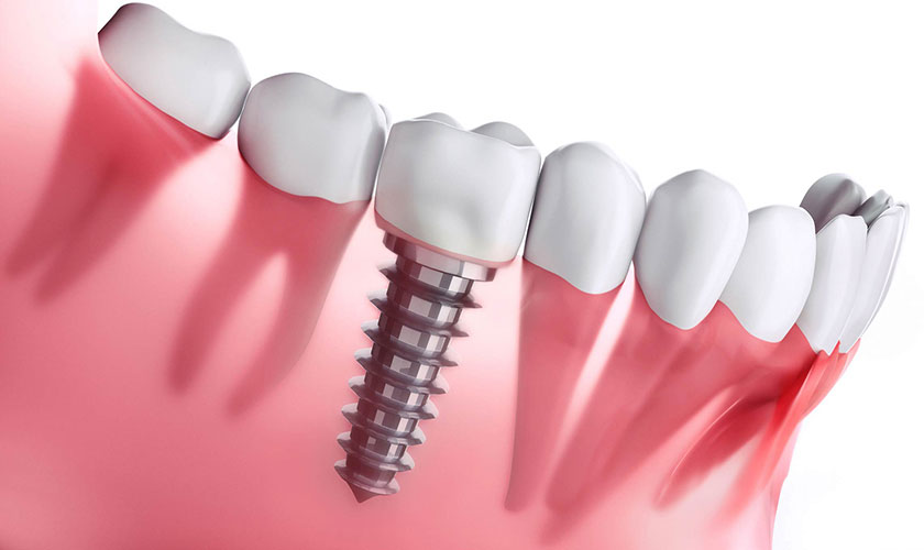 8 lợi ích khi cấy ghép răng Implant