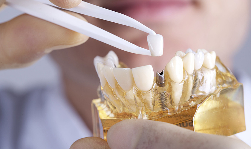 Cấy ghép răng Implant mang lại kết quả lâu dài nếu được chăm sóc đúng cách