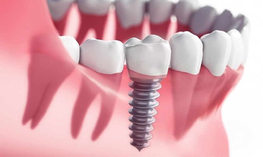ác bệnh lý về răng không thể xảy ra đối với Implant phục hồi