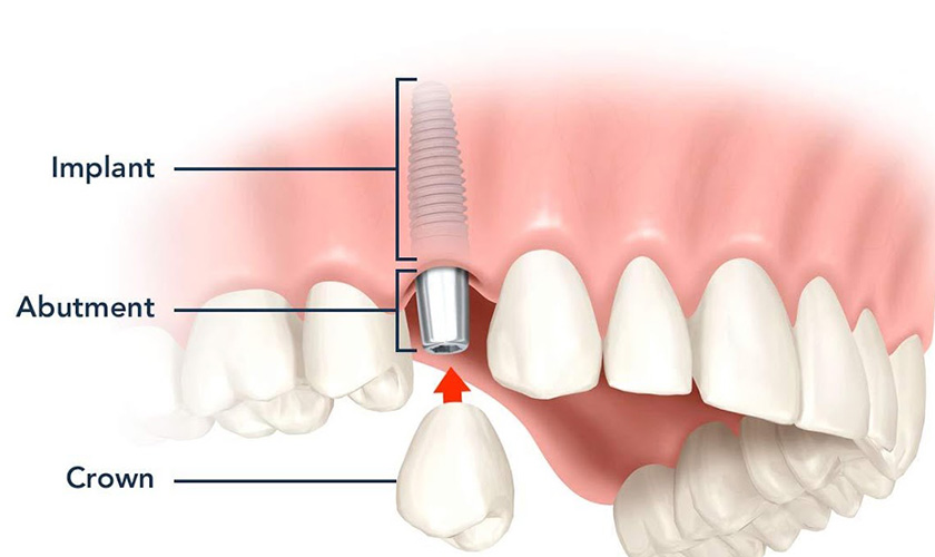Cấy ghép răng Implant mất bao lâu thì lành?