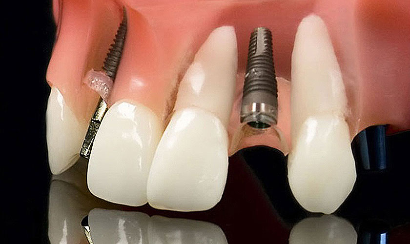 Trồng răng Implant Mỹ là một trong những kỹ thuật phục hình răng hàng đầu hiện nay