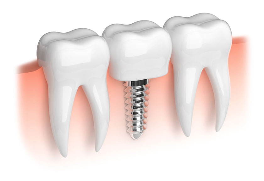 Giá cấy răng Implant rất xứng đáng với chất lượng mà phương pháp này đem lại