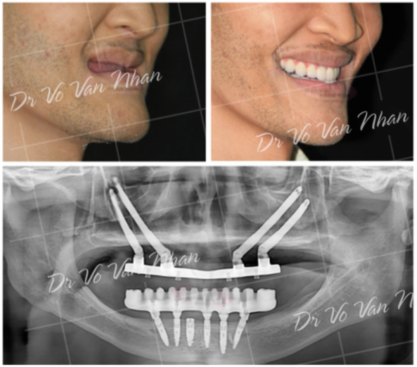 Điều trị bệnh nhân không răng bẩm sinh (*)