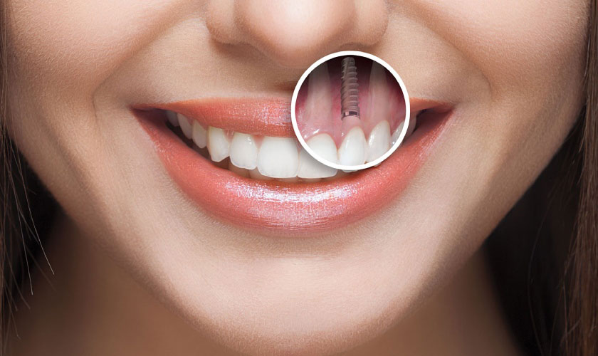 Răng Implant mang đến nhiều ưu điểm vượt trội