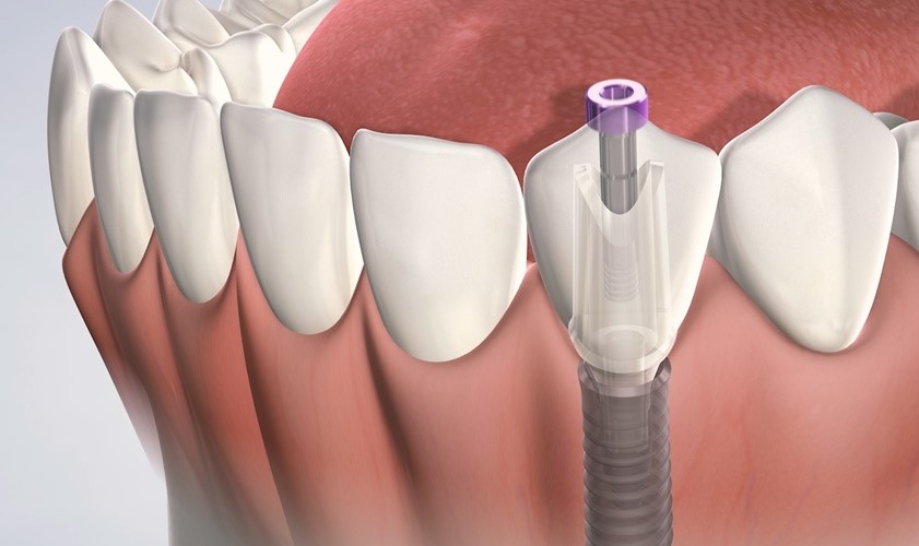Chuyên gia giải đáp những thắc mắc khi trồng răng Implant