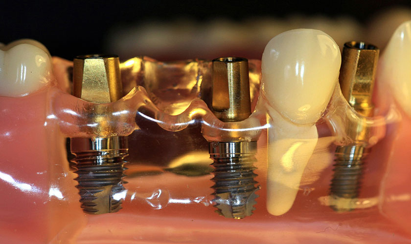 Lưu ý sau khi cấy ghép Implant cần chăm sóc răng miệng tốt để đạt kết quả thành công và nhanh chóng