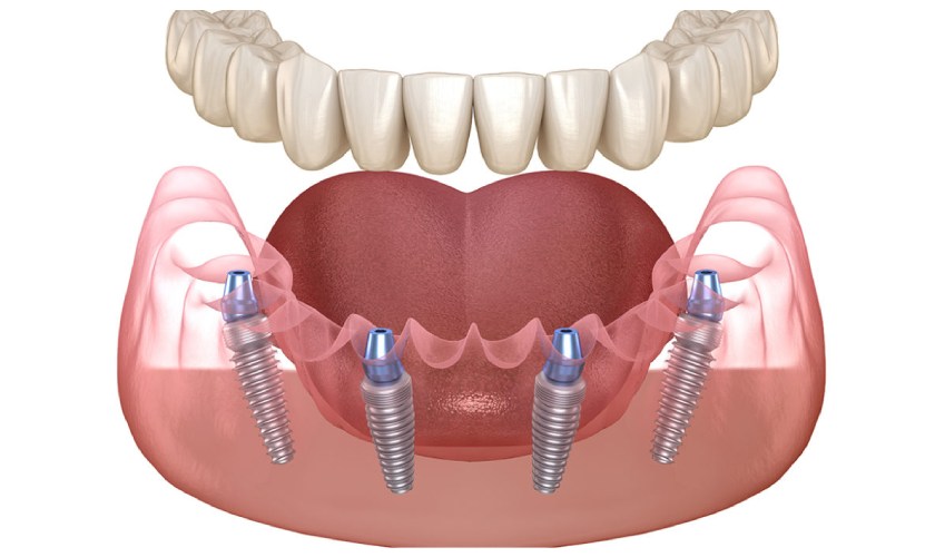 Trồng răng Implant all on X được nhiều người ưa chuộng hiện nay