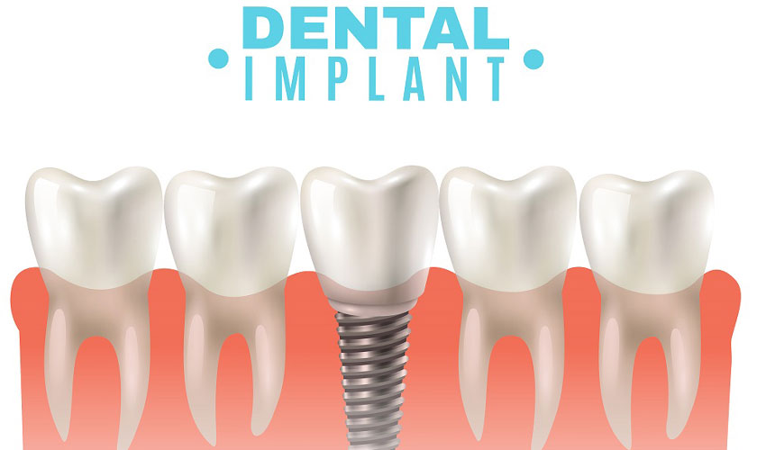Có nên trồng răng Implant để phục hồi răng bị mất ?