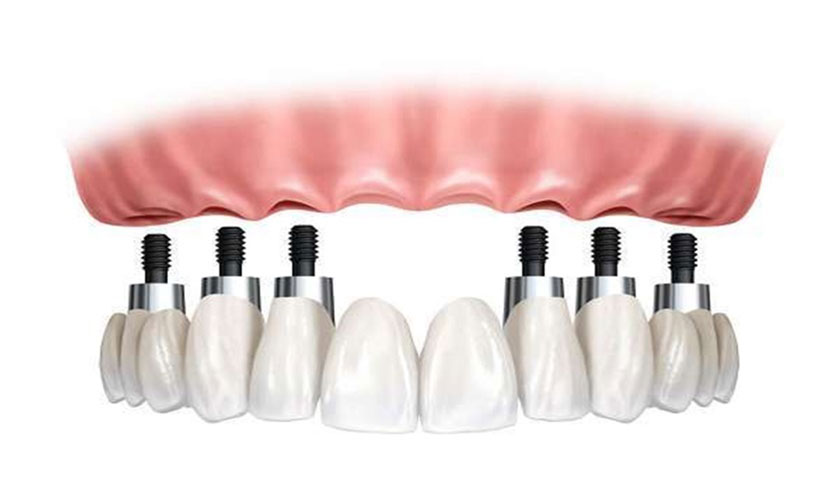 Cấy ghép răng Implant