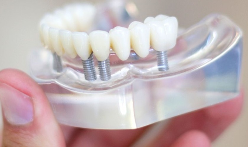 Làm răng Implant khi bệnh nhân đạt sức khỏe theo yêu cầu