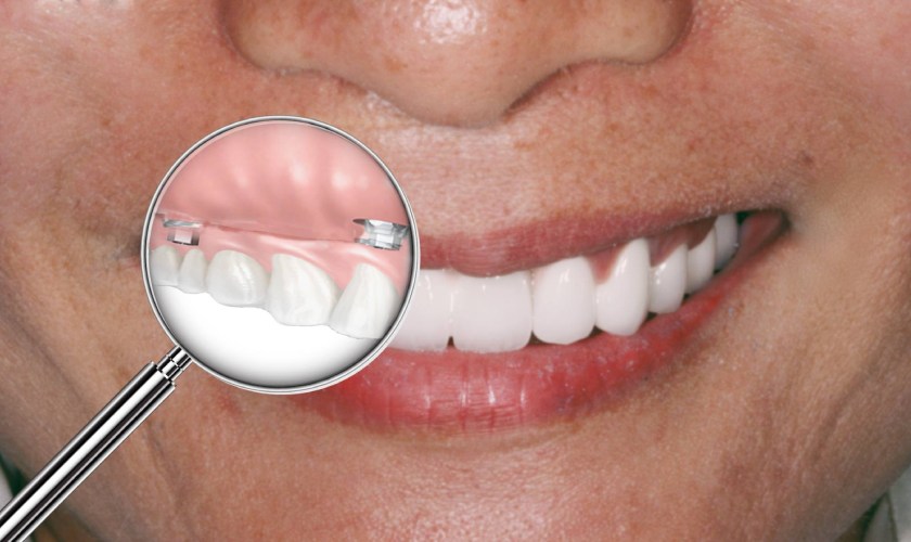 Có nên trồng răng Implant để phục hồi răng mất toàn hàm?