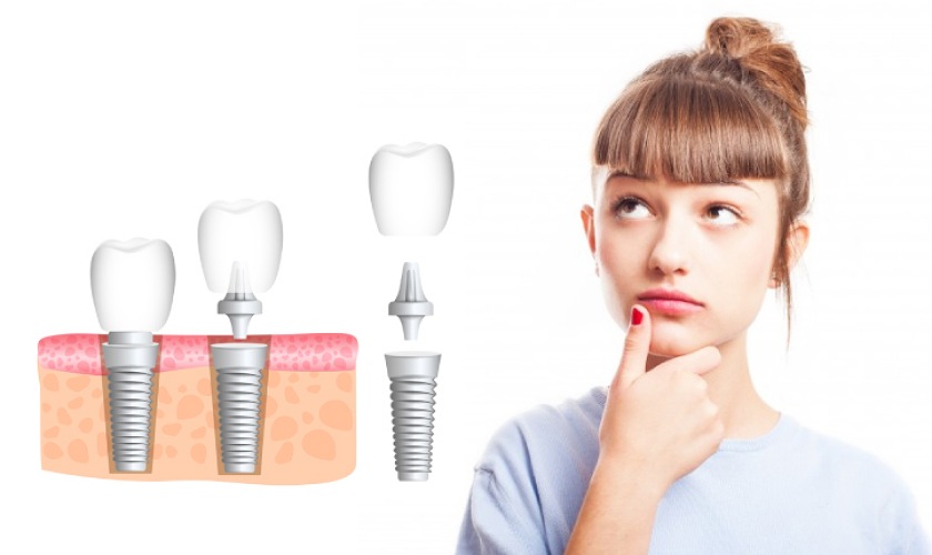 Trồng răng Implant: Điều trị mất răng hiệu quả và an toàn