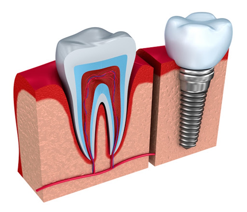 Răng Implant