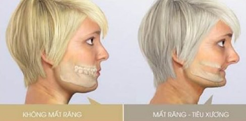 Mất răng lâu năm khiến cho xương hàm tự tiêu hủy