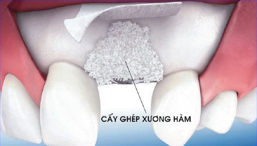 Ghép xương cấy Implant cần đảm bảo điều kiện gì?