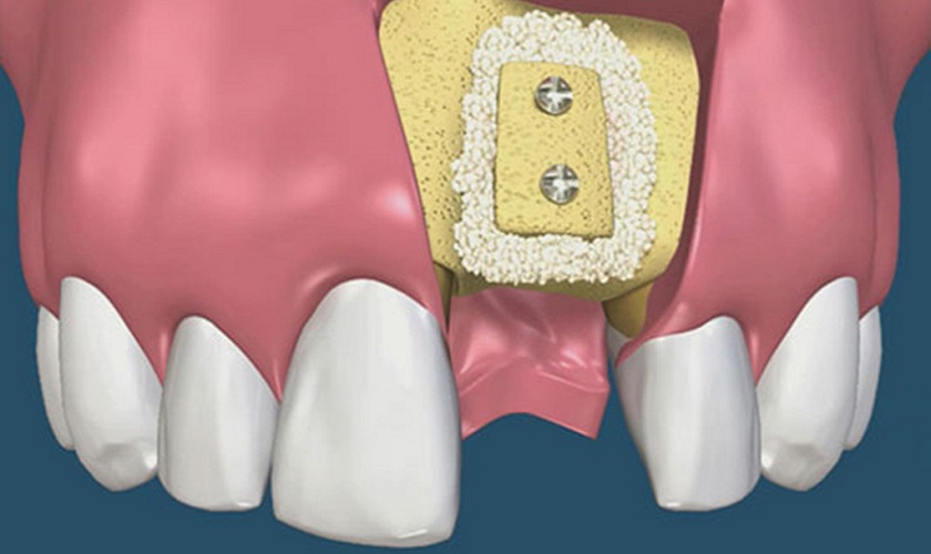 Ghép xương cấy Implant là gì? Khi nào cần thực hiện