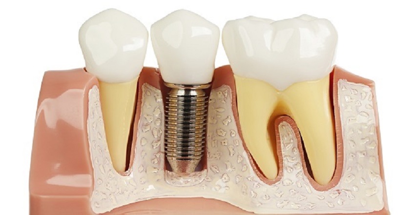 Giá cấy răng Implant hiện nay có cao không?