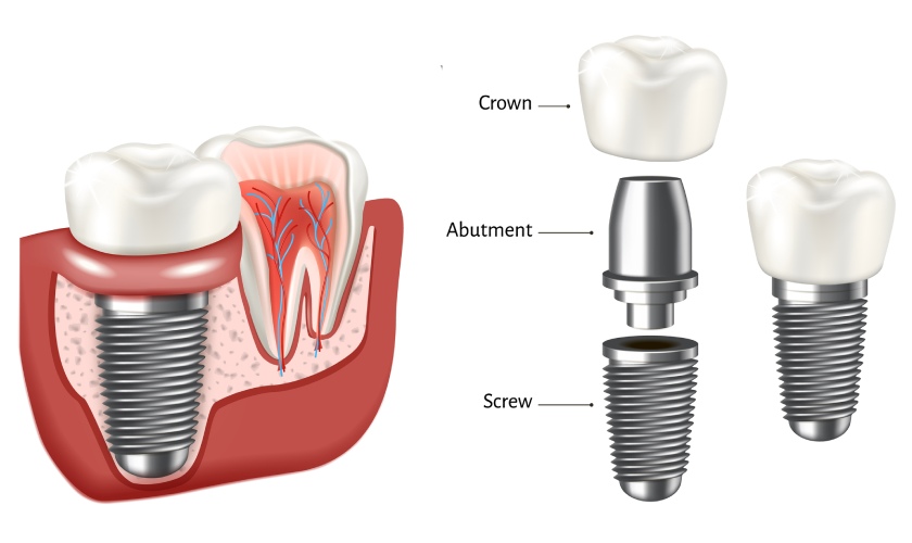 Giá trồng răng implant tại Nha khoa Nhân Tâm bao nhiêu tiền?