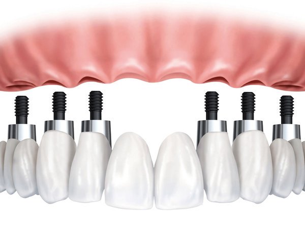 Kết hợp làm cầu răng sứ với Implant có được không