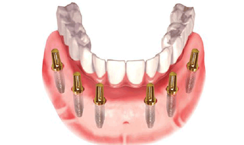 Kết hợp làm cầu răng sứ với Implant có được không