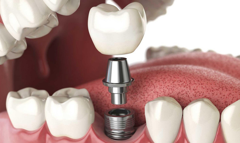 Phương pháp cấy ghép răng Implant