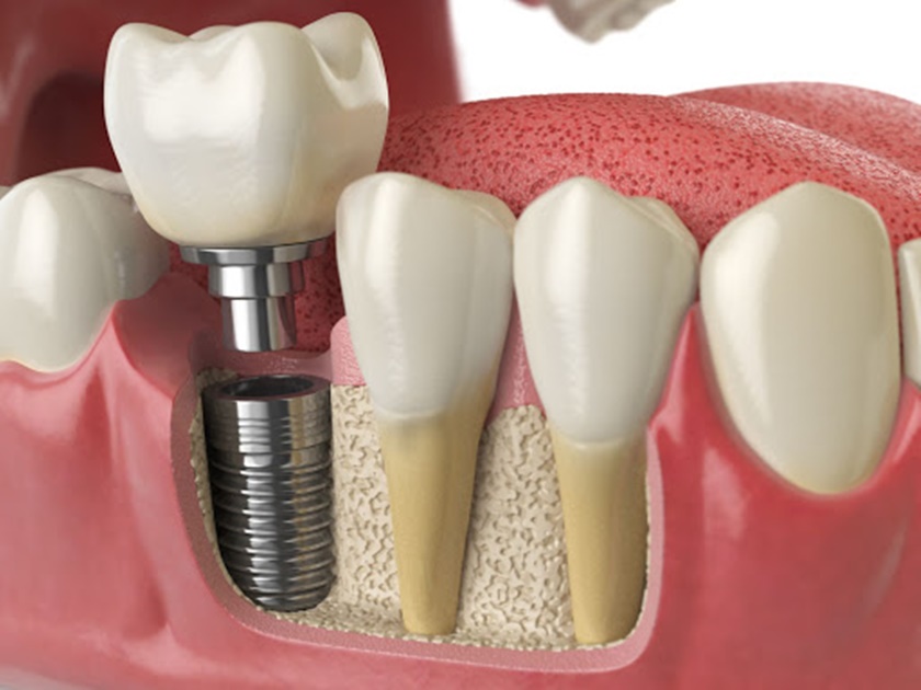 Implant nha khoa có nhiều ưu điểm