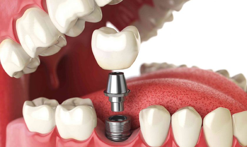 Cấy ghép implant tức thì là giải pháp giúp rút ngắn tối đa thời gian cấy ghép răng