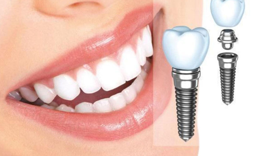 Cấy ghép răng implant giúp khôi phục răng mất như răng thật