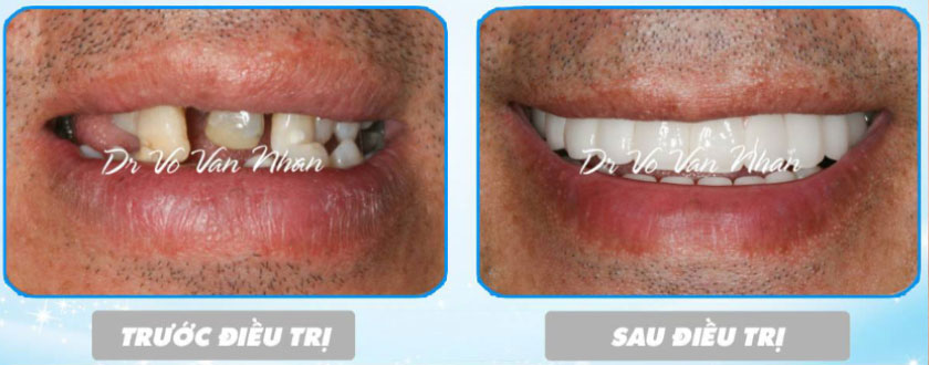 Hình ảnh trước và sau khi điều trị