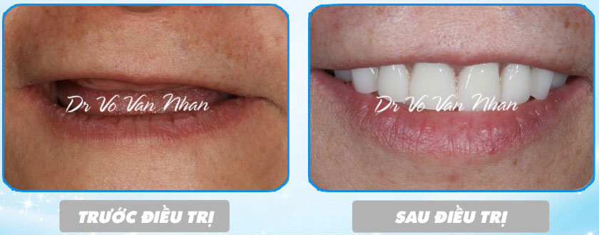 Hình ảnh trước và sau khi trồng răng implant